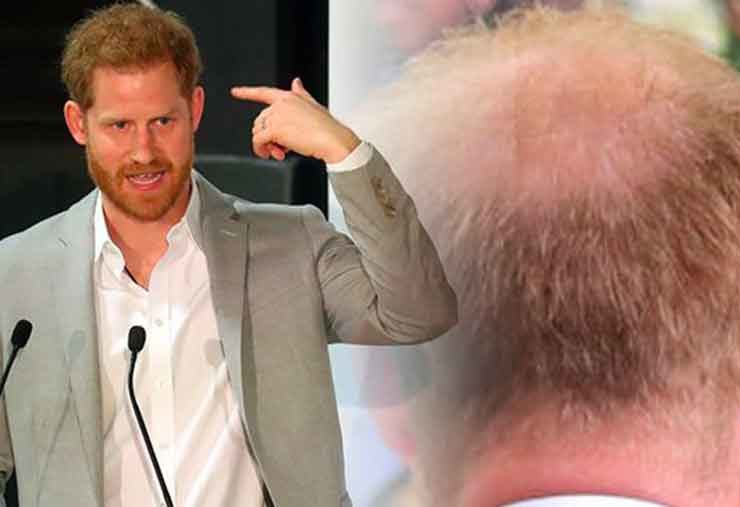 harry perd ses cheveux chauve